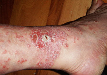 Antiseptic Skin Healing Cream with Nano Silver & Gold - SilverPlus Naturals