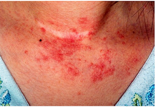 The Healing Power of Nano Silver and Gold: Unlocking Their Benefits for Skin Health